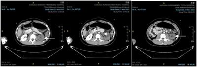 Traumatic renal artery thrombosis: a case report and literature review